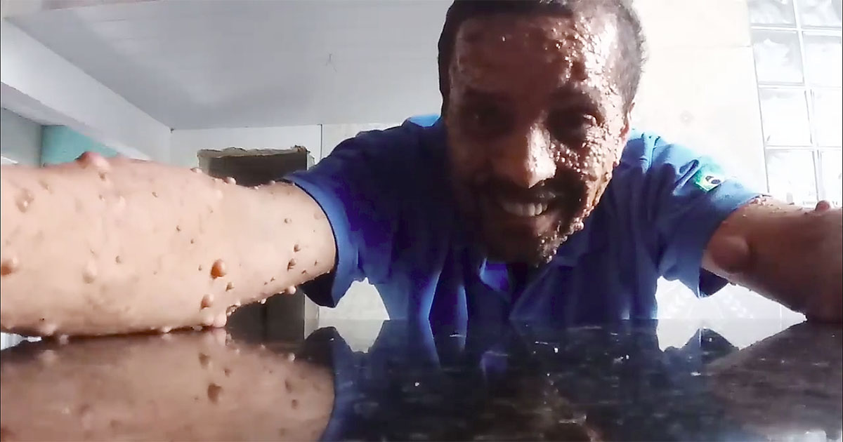 Refrigerista com neurofibromatose Luiz Carlos dos Santos Sales